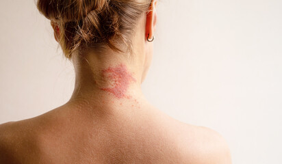 Manifestation of atopic dermatitis as a red itchy spot on a woman’s neck, close-up, rear view, copy space. Dermatology, allergy, itching, red spot or rash on skin