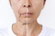 Lower part of face and neck of elderly woman with signs of skin aging before after plastic surgery. Age-related changes, flabby sagging skin, wrinkles, creases, puffiness. Rejuvenation, facelift