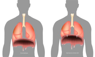 Wall Mural - Normal diaphragm or Diaphragmatic eventration. Abnormal elevation of a portion or entire hemidiaphragm. Paralysis of the diaphragm