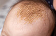 The process of formation of seborrheic dermatitis in an infant on the head. Scaly crusts, close-up