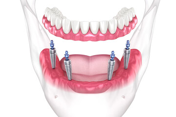 Wall Mural - Mandibular removable prosthesis All on 4 system supported by implants with ball attachments. Medically accurate dental 3D illustration