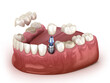 Tooth recovery with implant crown and bridge. Medically accurate 3D illustration dental concept.