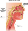 Medical illustration of symptoms of Post-Nasal Drip, with annotations.