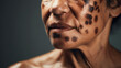 Vitiligo , close-up of age pigment spots on the face skin of an old human, cosmetic procedure for the removal of vitiligo by laser. Melanoma, a malignant mole on the skin. 
