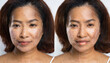 cropped image before and after spot melasma pigmentation facial treatment on middle age asian woman face skincare and health problem concept
