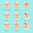 Dental diseases teeth caries pulpitis cyst gingivitis periodontitis. Medical illustration. Stomatology