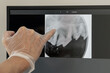 precision in dentistry: navigating tooth health with x-ray expertise