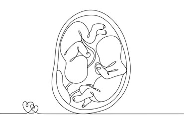 Wall Mural - pregnancy. twins. monozygotic. one line