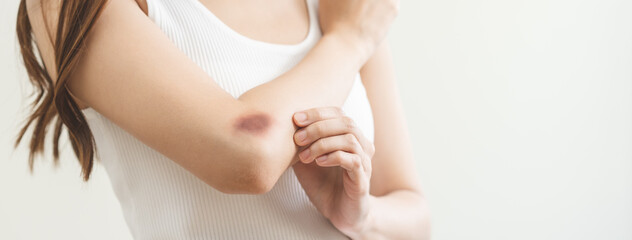 Wall Mural - Close up of stain bruise wound on arm, contusion asian young woman, girl an accident fell down stairs, hand on elbow in healing injury by massage hematoma blood. Extravasation blue, purple on skin.