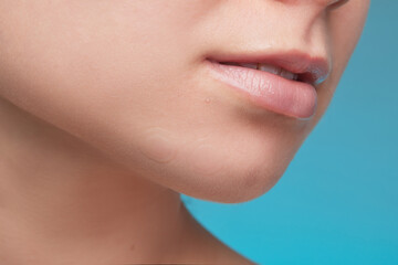 girl with acne stick round acne patch on her cheek. using acne patches for treatment of pimple and r