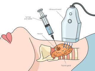 Wall Mural - Ultrasound guided thyroid biopsy puncture structure diagram hand drawn schematic vector illustration. Medical science educational illustration