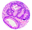 Photomicrographic view of histological stained slide showing carcinoma. Adenocarcinoma