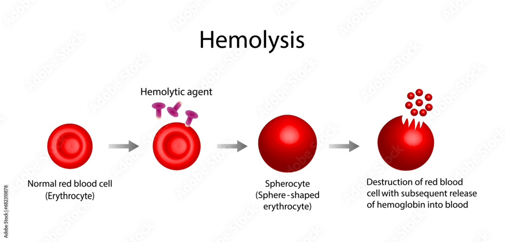 Hemolysis. Normal red blood cell, spherocyte, then destruction of red