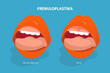 3D Isometric Flat Vector Illustration of Frenuloplastika, Lip Tie Before and After Surgery