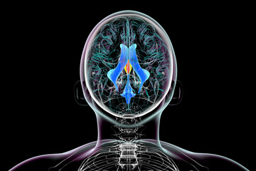 Canvas Print - Enlargement of the third brain ventricle, 3D illustration