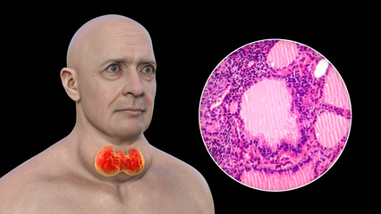 Wall Mural - A man with enlarged thyroid gland, 3D illustration, and micrograph toxic goiter