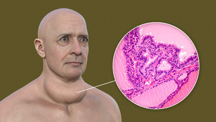 Canvas Print - A man with enlarged thyroid gland, 3D illustration, and micrograph toxic goiter