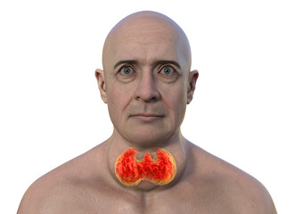 Poster - A man with enlarged thyroid gland, 3D illustration