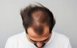 © Oksana - Brunette man with alopecia, hair loss is showing his sparse hair on white background, top view, close-up. Baldheaded man