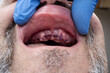 Male palate with gum grafts after extraction of all teeth.