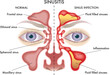 Medical  illustration of symptoms of Sinusitis.