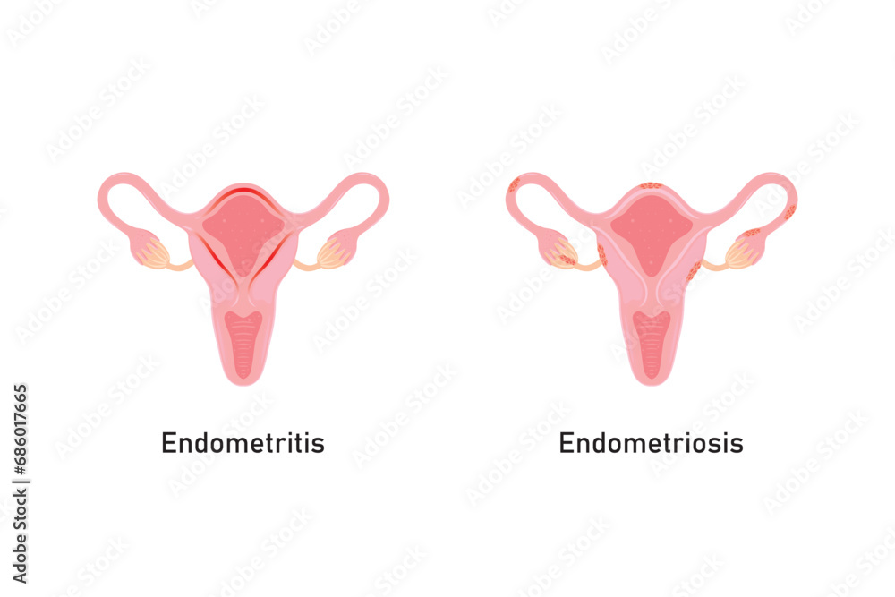 Endometriosis and Endometritis Scientific Design. Vector Illustration ...