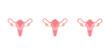 © Kooto - Endometriosis and Endometritis Scientific Design. Vector Illustration.