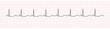 EKG Monitor Showing  Sinus Rhythm with U wave represented Hypokalemia