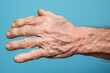 © EdNurg - The rough and swollen hand of a senior male, depicting the challenges of geriatric health and the concept of elderly care.