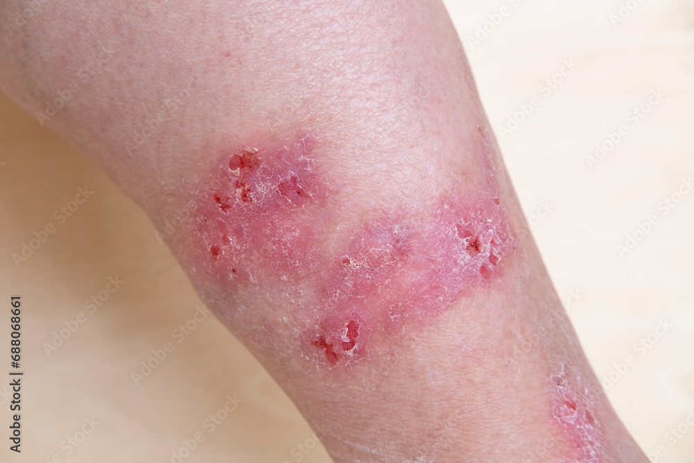 Rash Hives Itchy Skin On Legs Inflammation And Allergy Disease On Rash Hives Itchy Skin On Legs Inflammation And Allergy Disease On