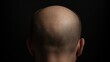 © Sandris_ua - Receding Hairline leading to Partial or Complete Baldness.