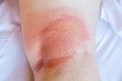 © vvoe - sample of atopic dermatitis - eczema dermatitis under knee close up