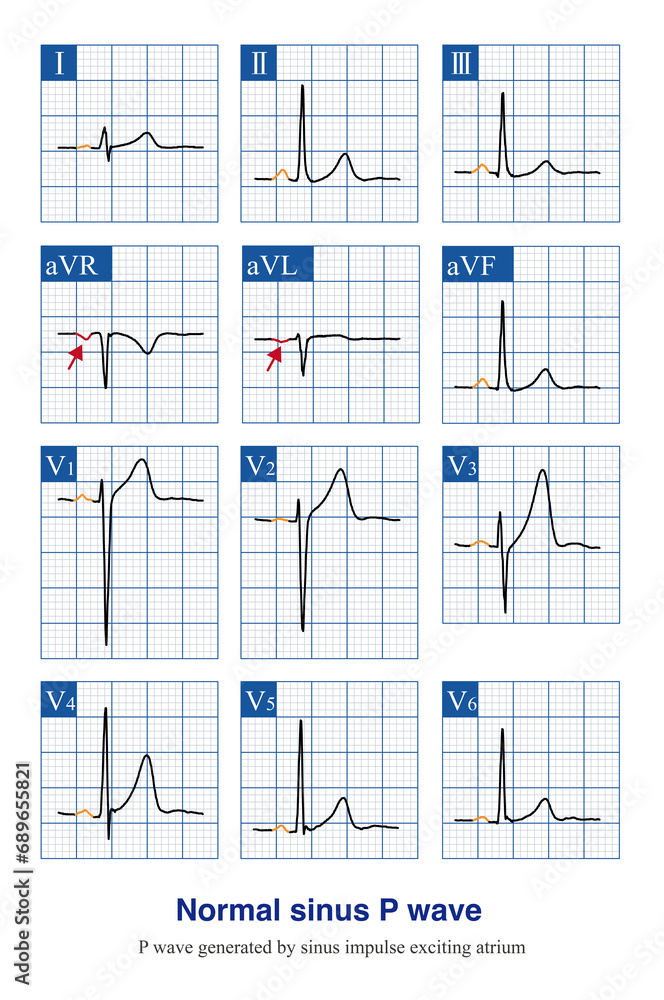 Under normal circumstances, the sinus P wave is the first ECG wave, as ...