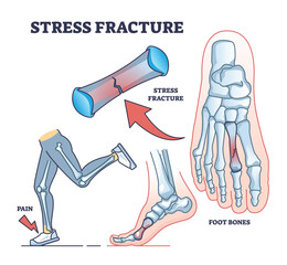 Poster - Stress fracture explanation with skeletal foot bone injury outline diagram. Labeled educational scheme with phalanges tear after physical running activities and overuse in walking vector illustration