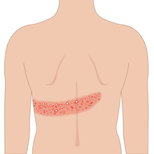 Red Shingles Rash Allergy On The Back Skin  Body, Illustration On White Background