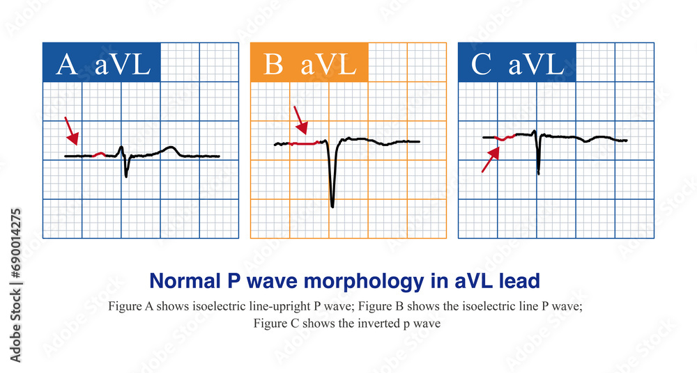 Ilustración de Stock For aVL leads, the morphology of normal P wave is ...