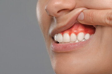 Poster - Woman showing inflamed gum on grey background, closeup. Space for text