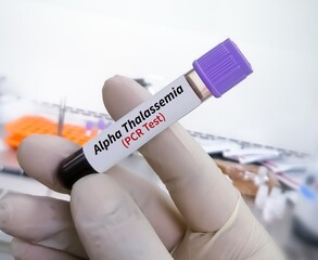 Sticker - Blood sample in hematologist hand for Alpha Thalassemia PCR testing 