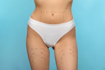 Canvas Print - Slim woman with markings on body before cosmetic surgery operation on light blue background, closeup