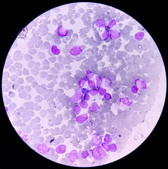 Wall Mural - Leukemia. blood cells, blast cells and immature leukocytic cells in chronic lymphocytic leukemia, prolymphocytic leukemia, acute lymphoblastic leukemia.