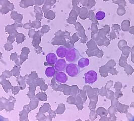 Wall Mural - Leukemia. blood cells, blast cells and immature leukocytic cells in chronic lymphocytic leukemia, prolymphocytic leukemia, acute lymphoblastic leukemia.