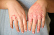 © Ladanifer - Unrecognizable woman with eczema on hands, atopic dermatitis concept.
