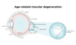 Age-Related Macular Degeneration Science Design Vector Illustration