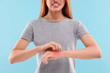 Canvas Print - Suffering from allergy. Young woman scratching her arm on light blue background, closeup