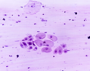 Canvas Print - Photomicrograph of Paps smear: Inflammatory smear with HPV related changes. Cervical cancer. SCC