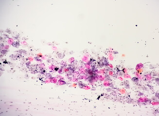 Canvas Print - Photomicrograph of Paps smear: Inflammatory smear with HPV related changes. Cervical cancer. SCC