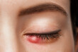 © Dimid - Eyes of a girl with stye close-up. Acute purulent inflammation of the hair follicle of the eyelashes of a young woman. Treatment and prevention of eye diseases.