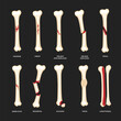 Set of different types of bone fracture collection, Diagram of leg fracture in different stages for infographic biology education school, Femur Bones, human anatomy poster.