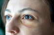 Beaten abused helpless scared wife with eye hematoma experiencing domestic violence, aggression, harassment, rudeness, bullying from husband. Female having black eye, trauma caused by accident fall 