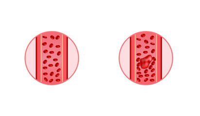 thromboembolism. circulating blood clot. normal blood flow and a thrombus in blood flow, embolus. re